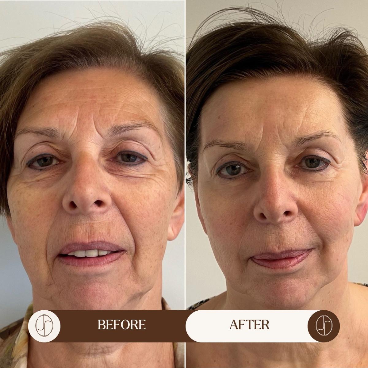 Vandaag! Last Minute bij Jenna Beauty Bar - LIFTOLOGY - LIPO