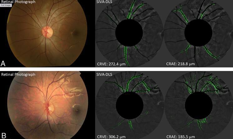 Estudio muestra cómo el ejercicio conduce a una vasculatura retiniana más saludable en niños Estudio muestra cómo el ejercicio conduce a una vasculatura retiniana más saludable en niños