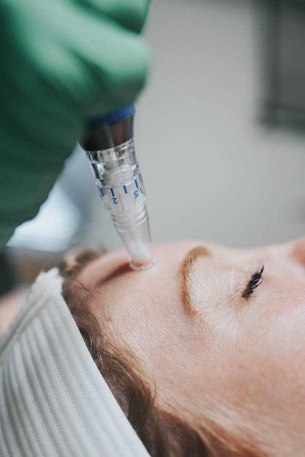 Microneedling