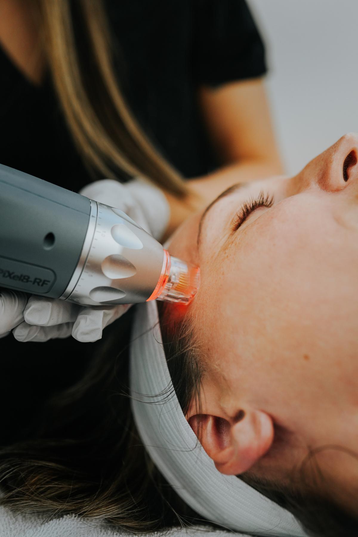 RF Microneedling