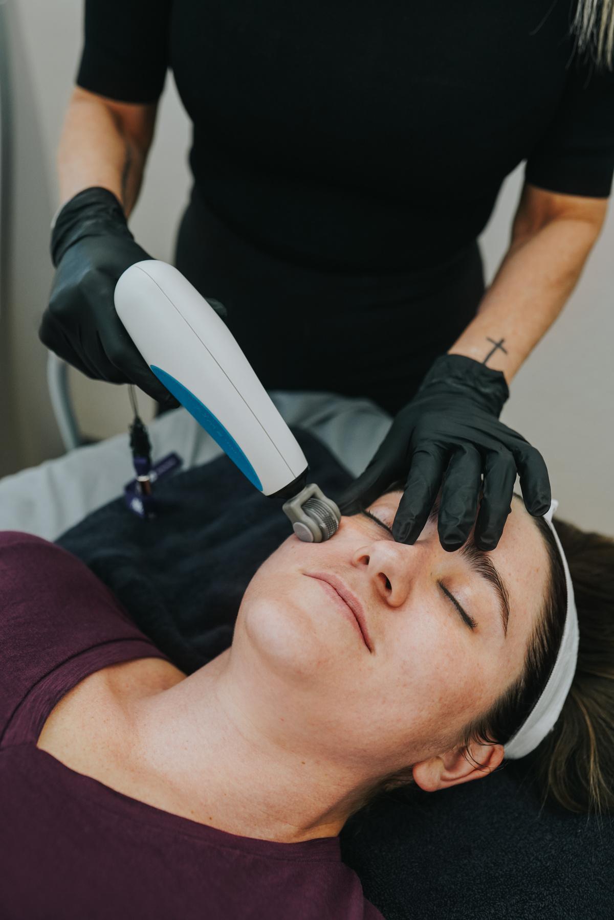 Fractional Plasma Skin Resurfacing