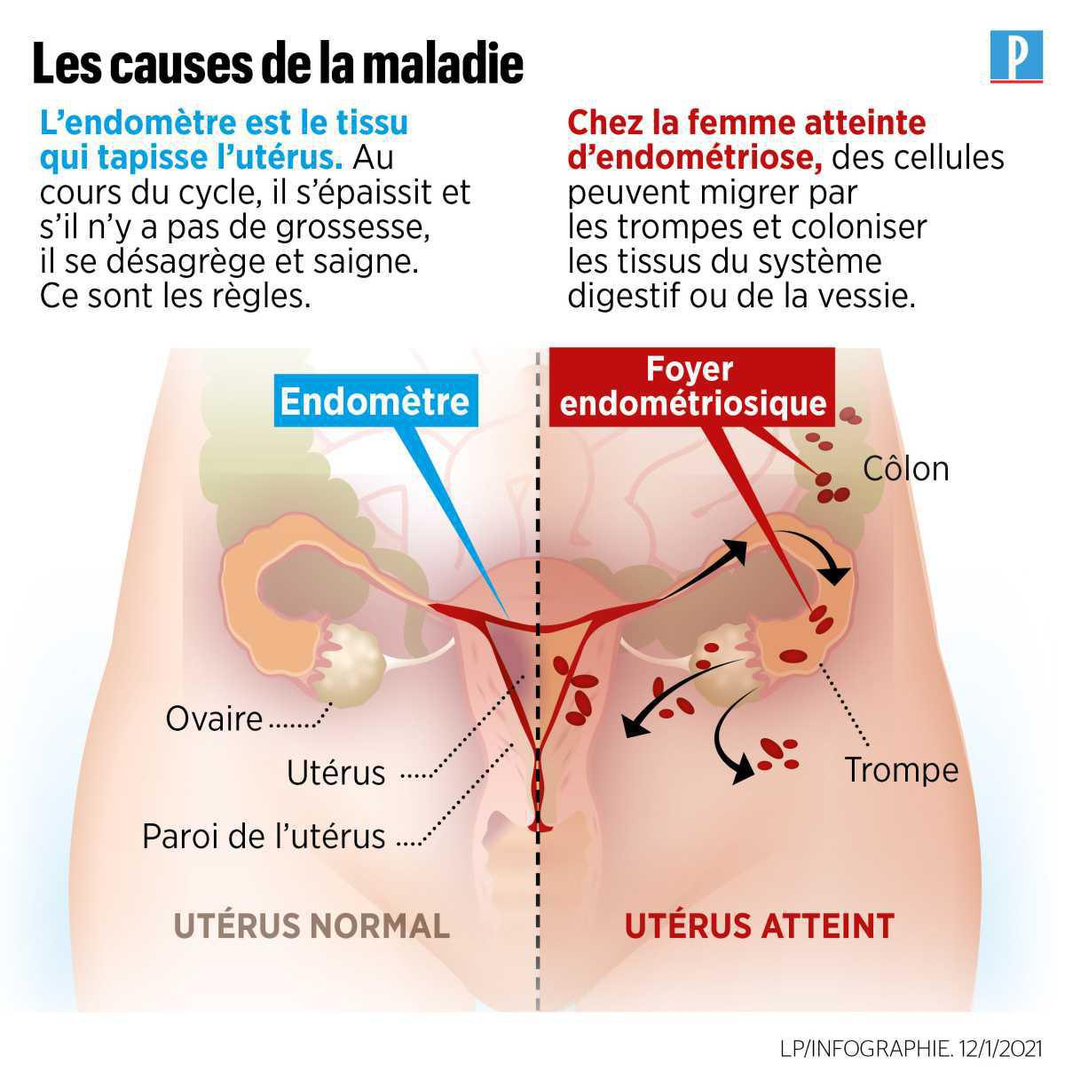 Endométriose : Une maladie encore mal connue mise en lumière en mars