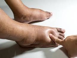 Bengkak pada bahagian kaki dan pergelangan kaki