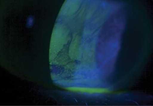 Se propone el índice de gravedad del ojo seco como una nueva herramienta para la evaluación de casos Se propone el índice de gravedad del ojo seco como una nueva herramienta para la evaluación de casos