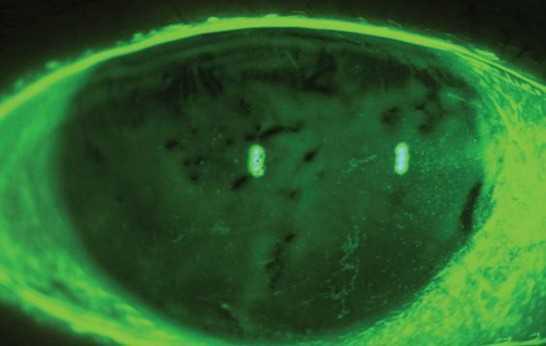 Un estudio demuestra que las lágrimas artificiales alteran el ciclo inflamatorio
