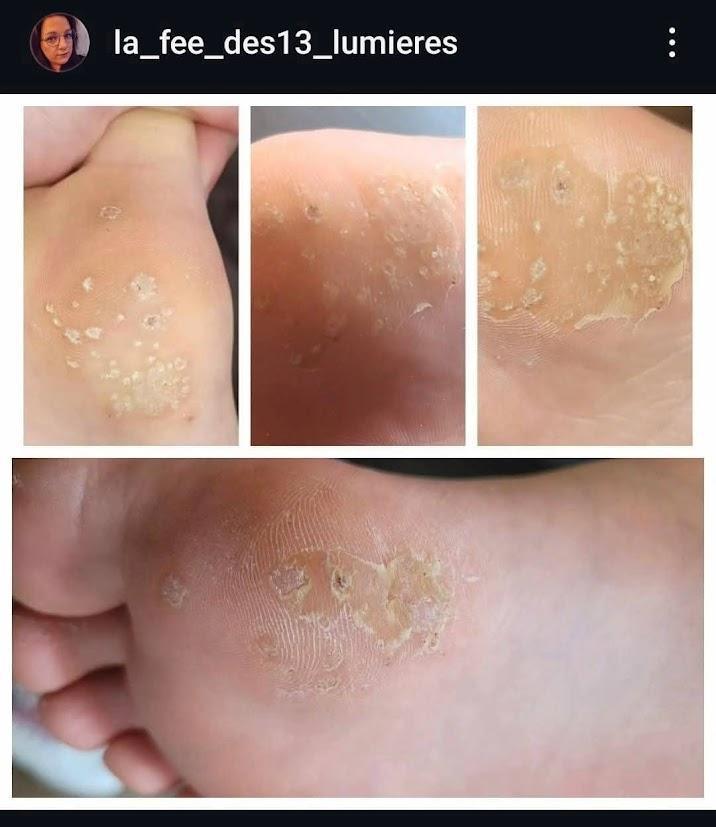 Retour sur verrues tenaces