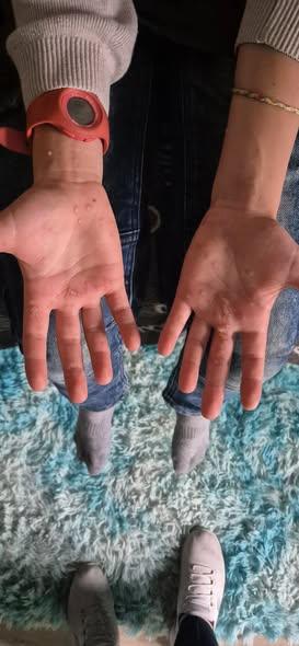 Retour verrues coriaces Retour verrues coriaces