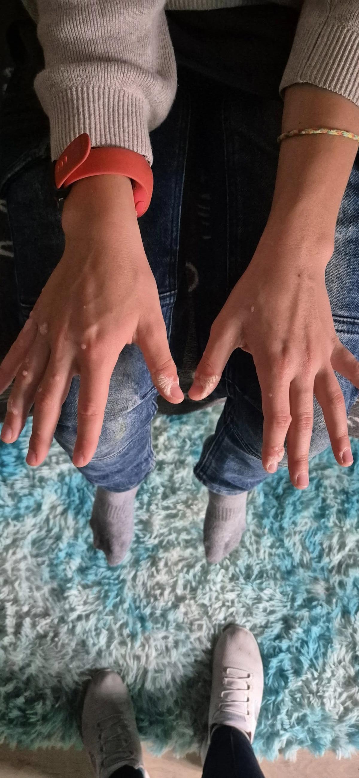 Retour verrues coriaces Retour verrues coriaces