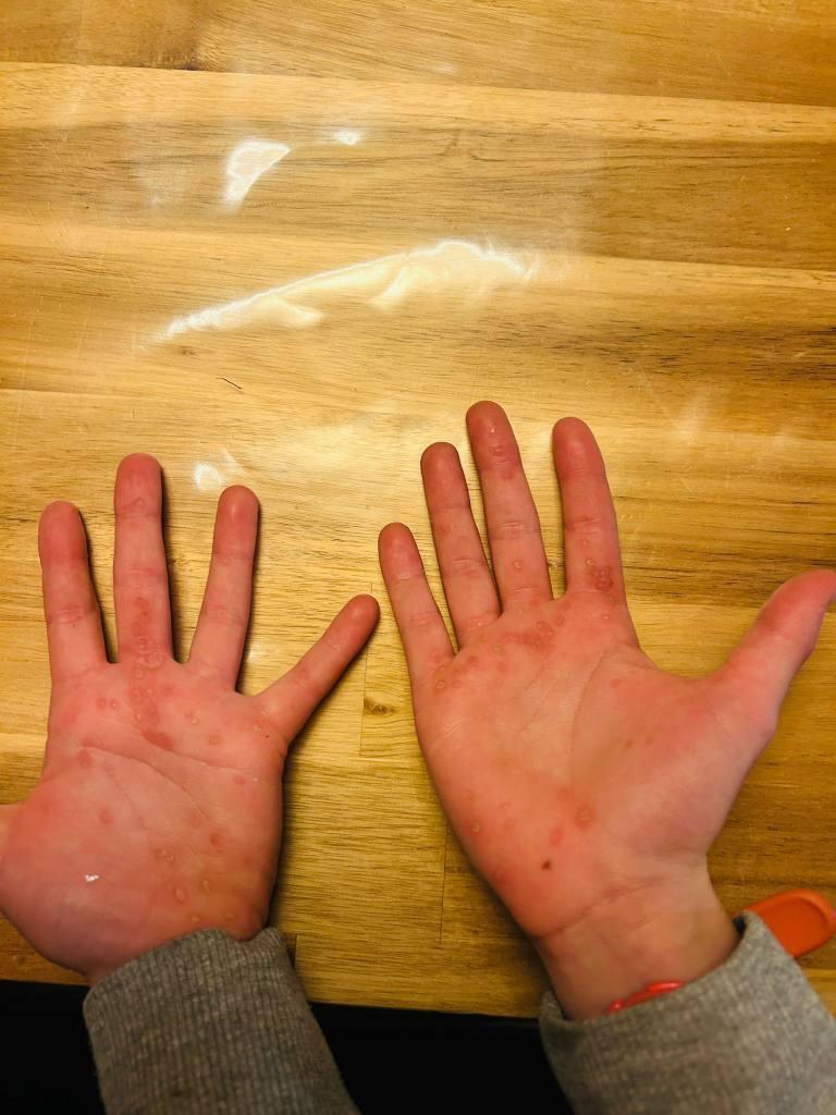 Retour verrues coriaces Retour verrues coriaces