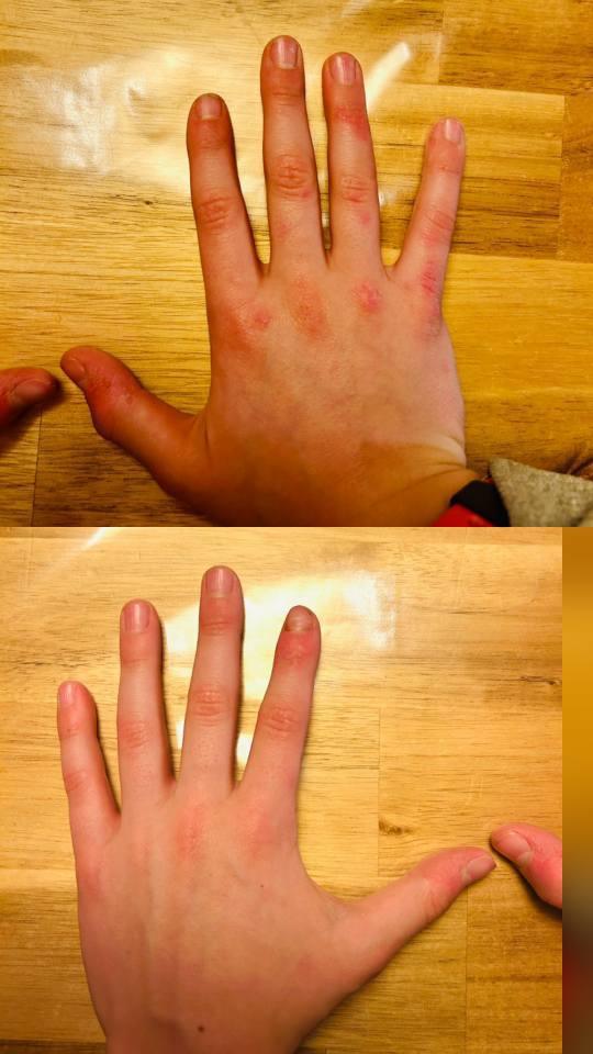 Retour verrues coriaces