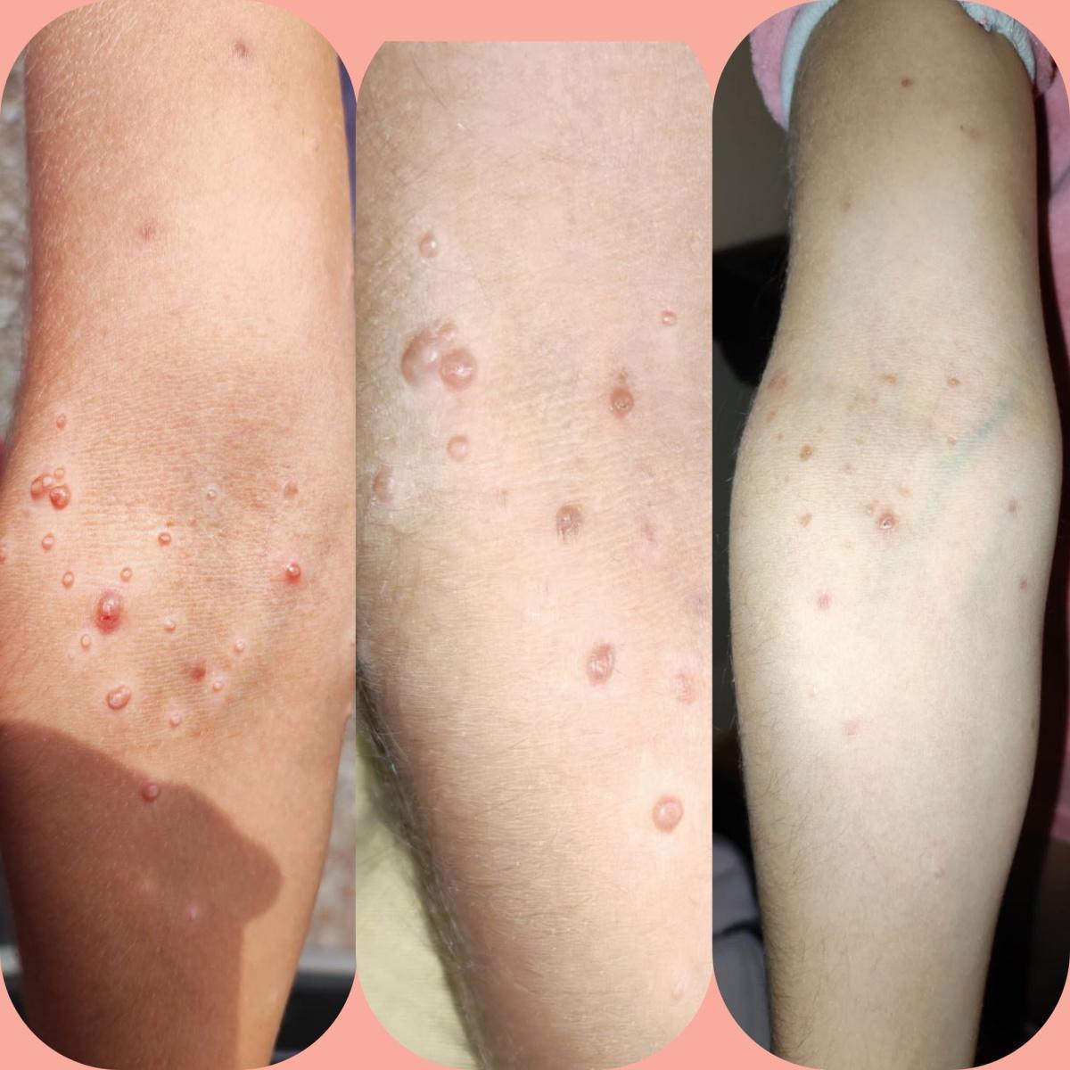 Retour molluscum tenace