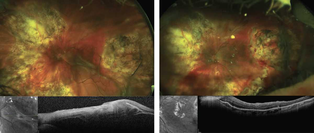 Terapias actuales para la PVR Terapias actuales para la PVR