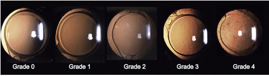 ¿Cuándo es seguro realizar una capsulotomía YAG para la opacificación capsular posterior (PCO)? ¿Cuándo es seguro realizar una capsulotomía YAG para la opacificación capsular posterior (PCO)?
