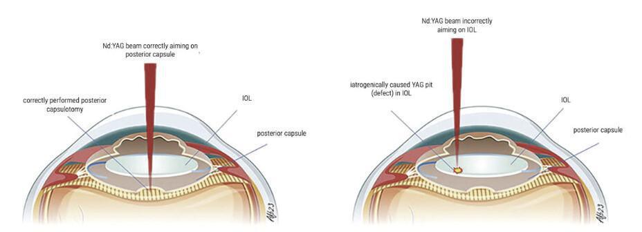 ¿Cuándo es seguro realizar una capsulotomía YAG para la opacificación capsular posterior (PCO)?