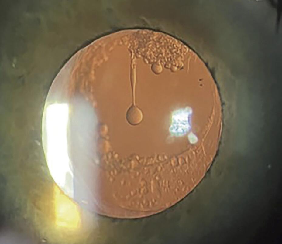 ¿Cuándo es seguro realizar una capsulotomía YAG para la opacificación capsular posterior (PCO)?