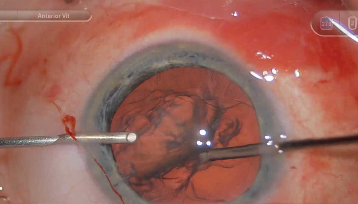 Cómo afrontar vitrectomías anteriores no planificadas Cómo afrontar vitrectomías anteriores no planificadas