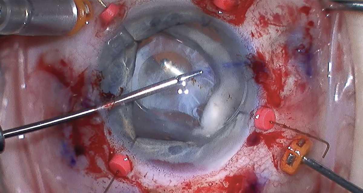 Cómo afrontar vitrectomías anteriores no planificadas Cómo afrontar vitrectomías anteriores no planificadas
