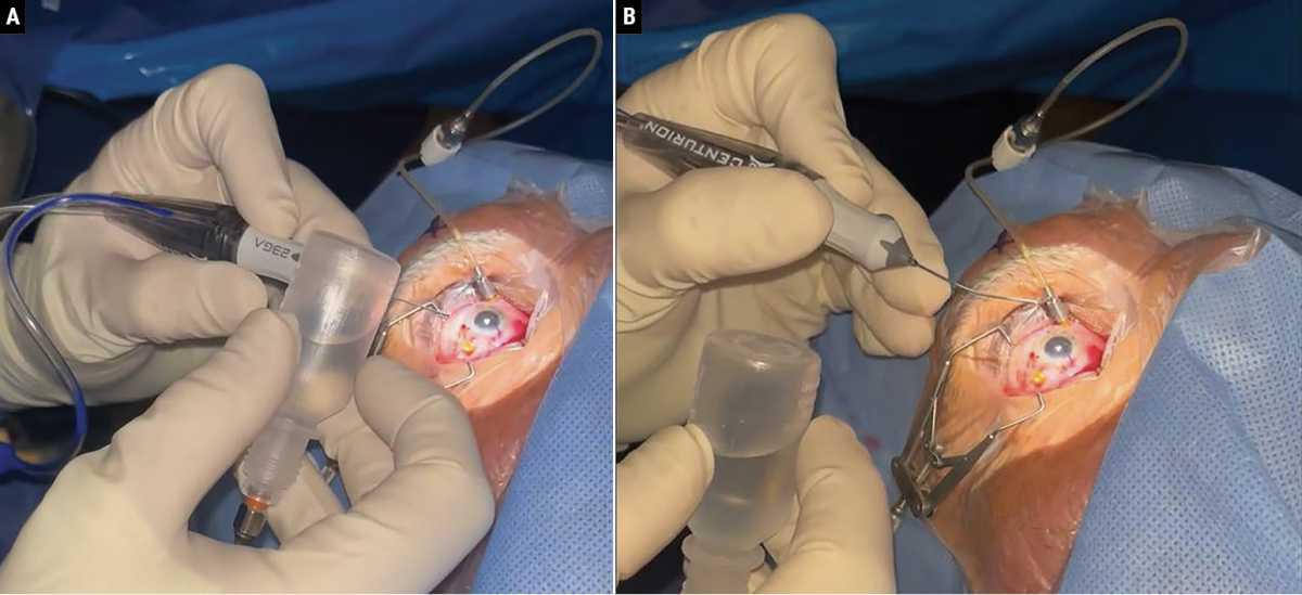 Cómo afrontar vitrectomías anteriores no planificadas Cómo afrontar vitrectomías anteriores no planificadas