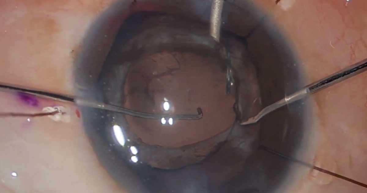 Cómo afrontar vitrectomías anteriores no planificadas Cómo afrontar vitrectomías anteriores no planificadas