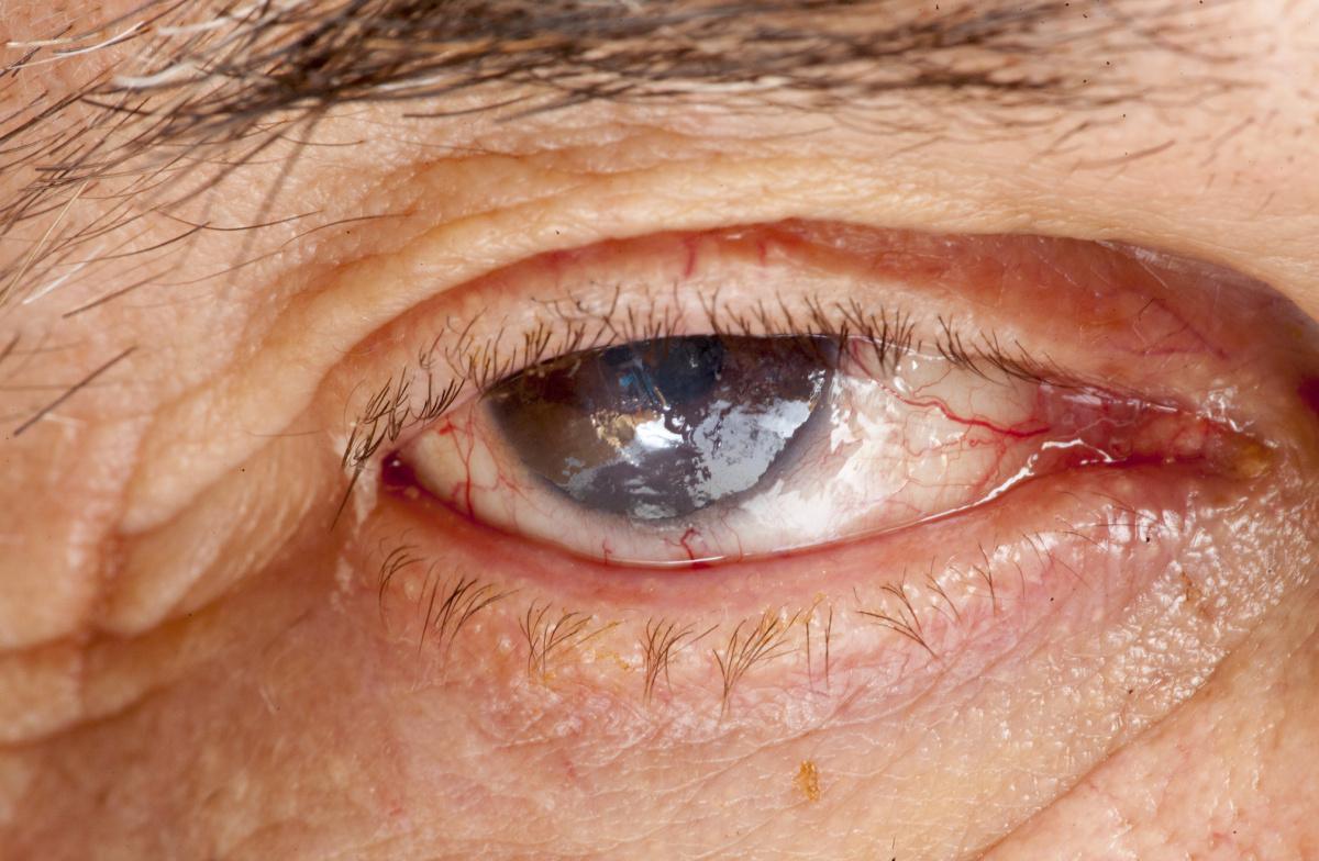 Cómo afrontar vitrectomías anteriores no planificadas Cómo afrontar vitrectomías anteriores no planificadas