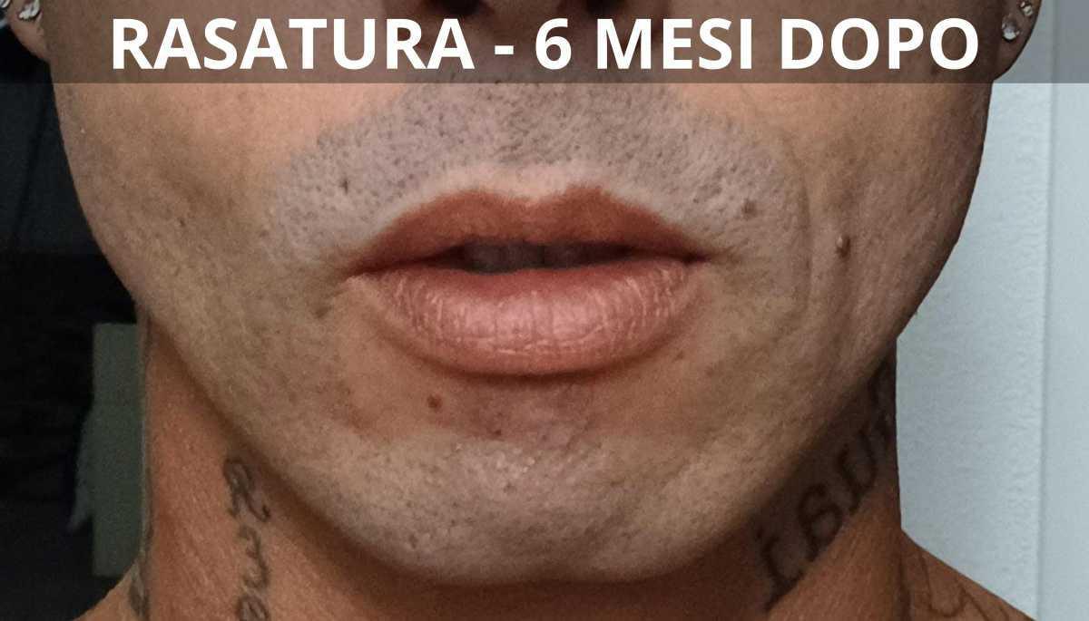 Risultati e aspettative nel trapianto di barba Risultati e aspettative nel trapianto di barba