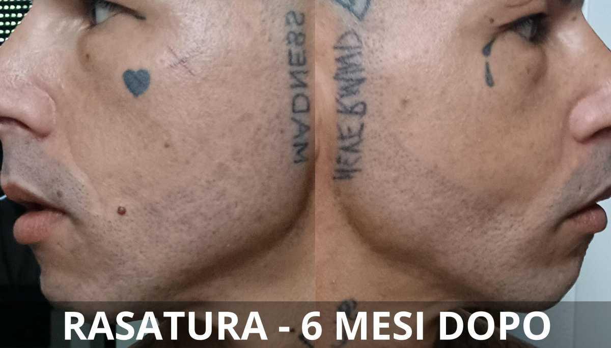 Risultati e aspettative nel trapianto di barba