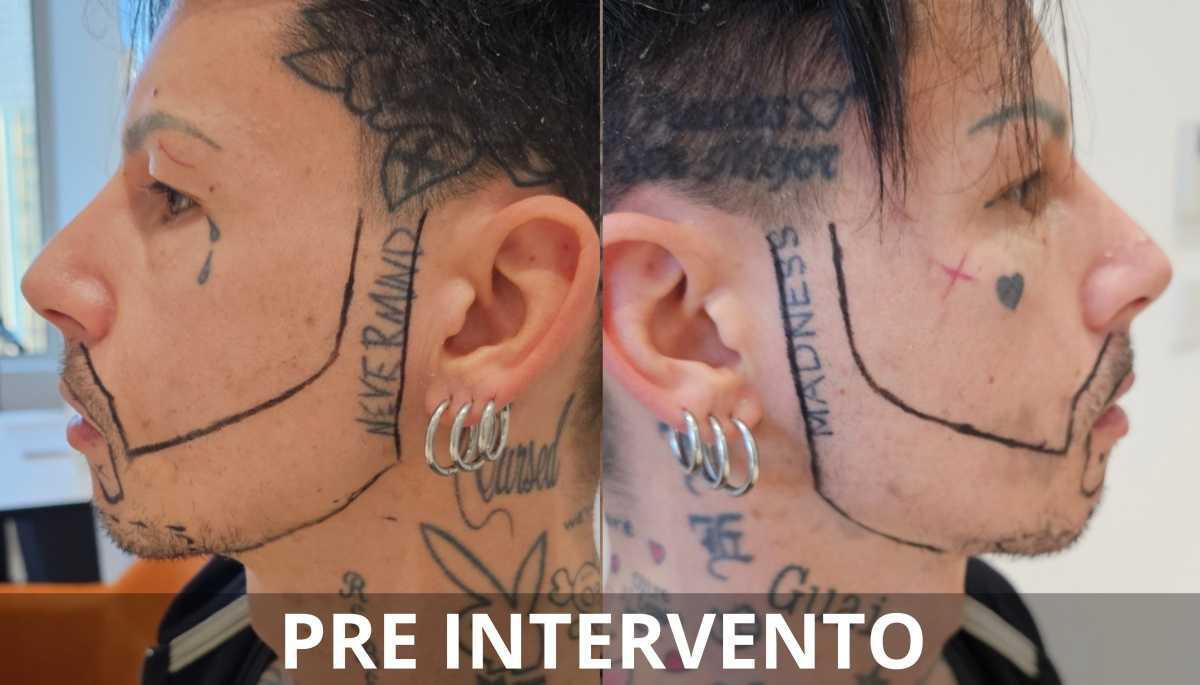 Risultati e aspettative nel trapianto di barba Risultati e aspettative nel trapianto di barba