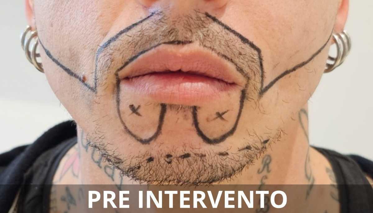 Risultati e aspettative nel trapianto di barba