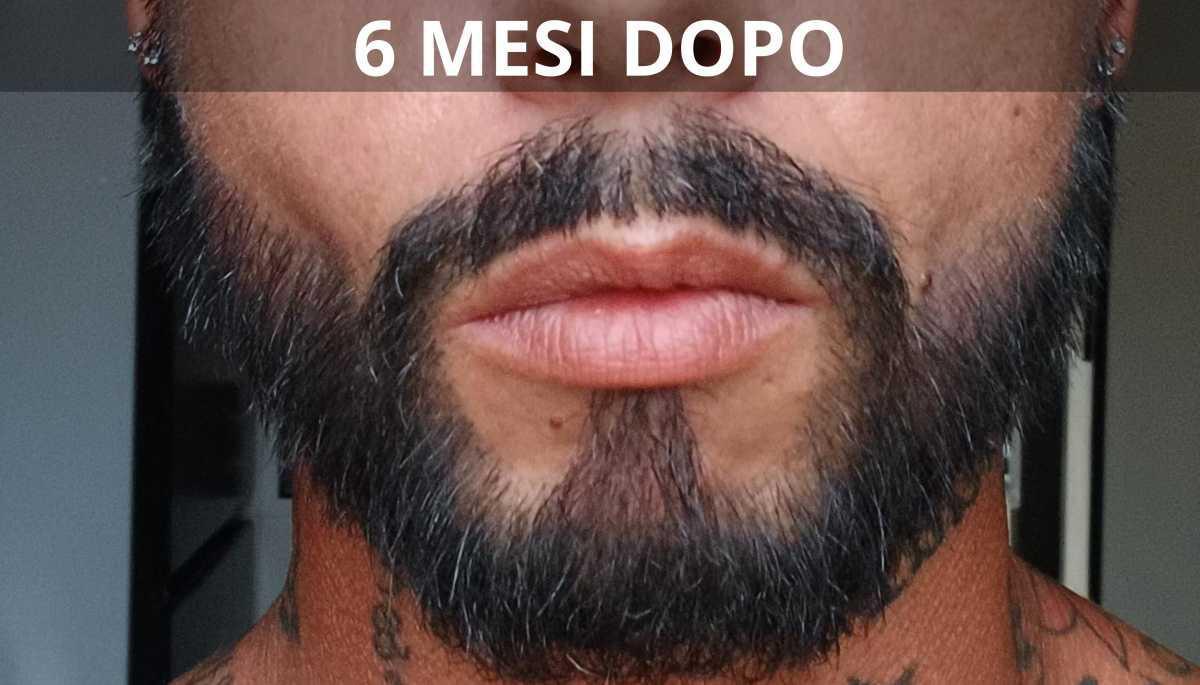 Risultati e aspettative nel trapianto di barba Risultati e aspettative nel trapianto di barba