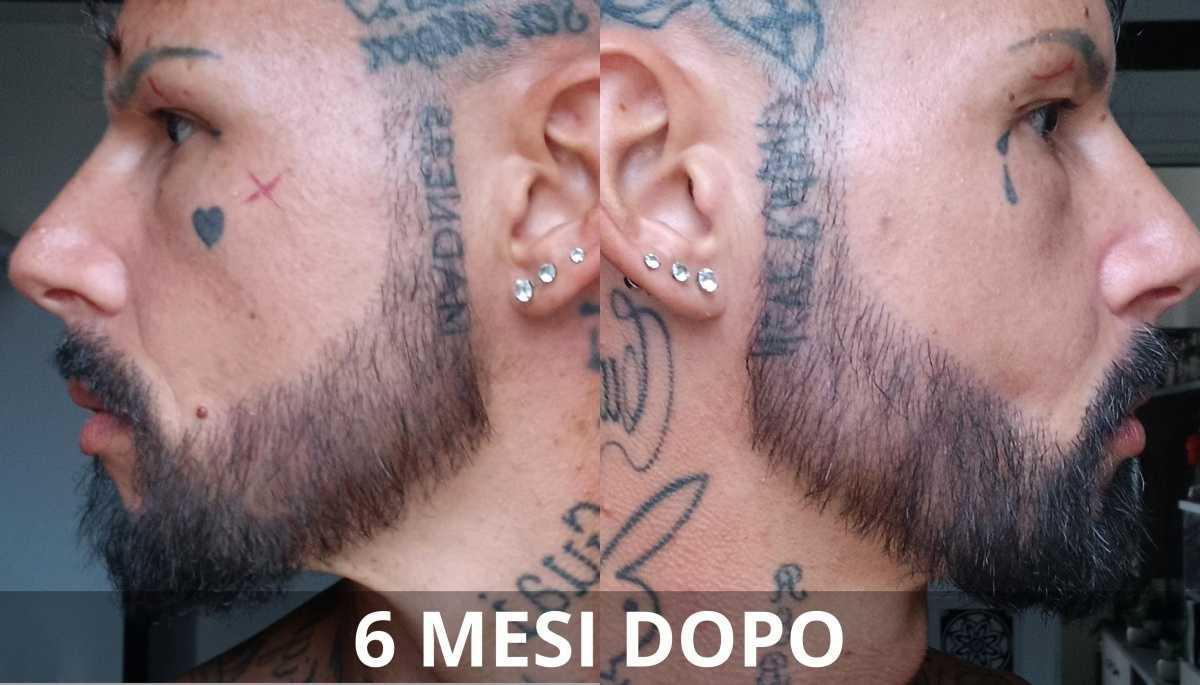 Risultati e aspettative nel trapianto di barba Risultati e aspettative nel trapianto di barba