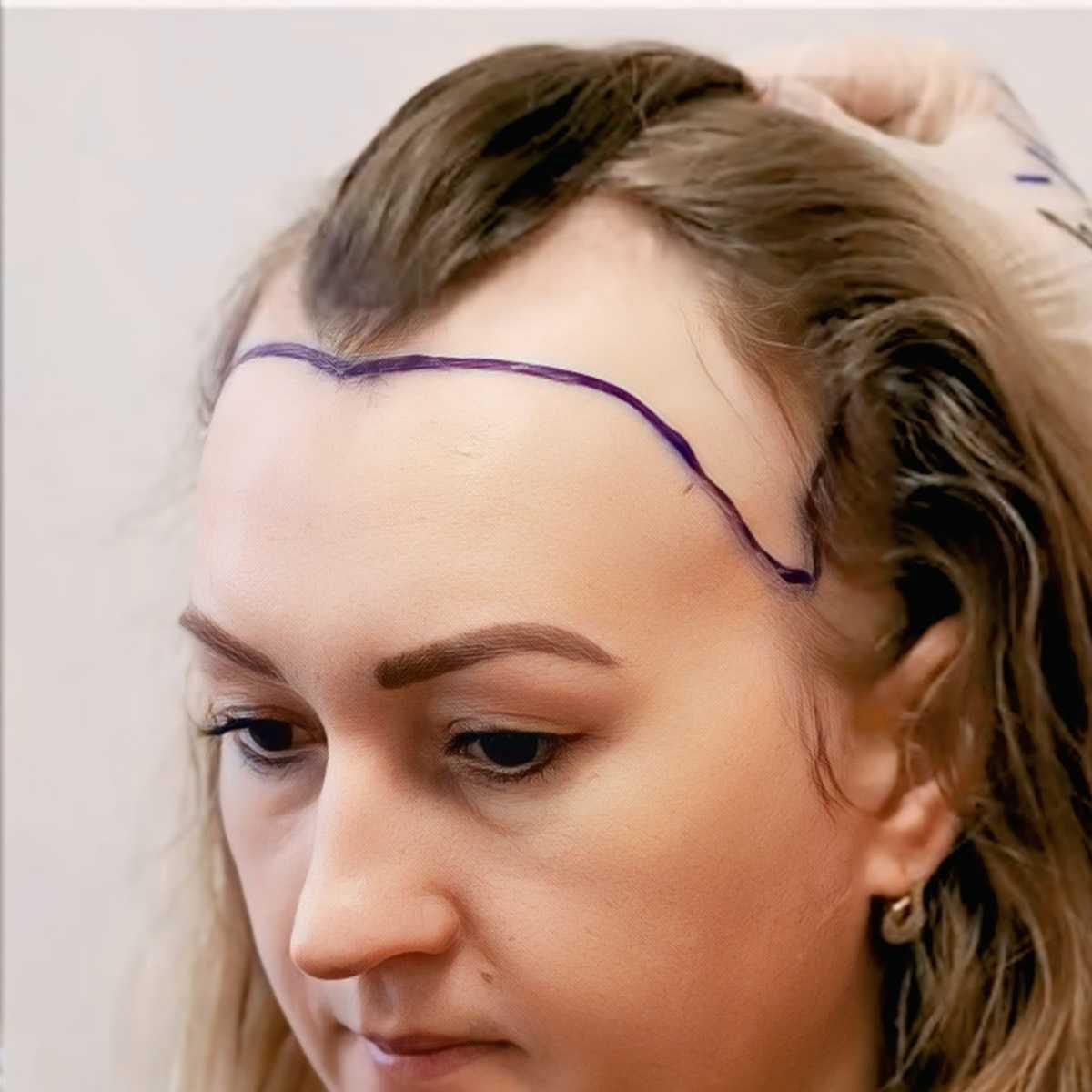 Progettazione dell'Hairline Femminile