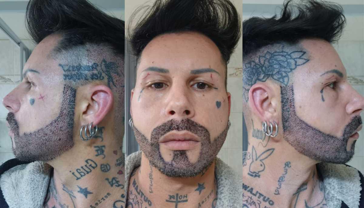 Post-Operatorio e recupero nel trapianto di barba