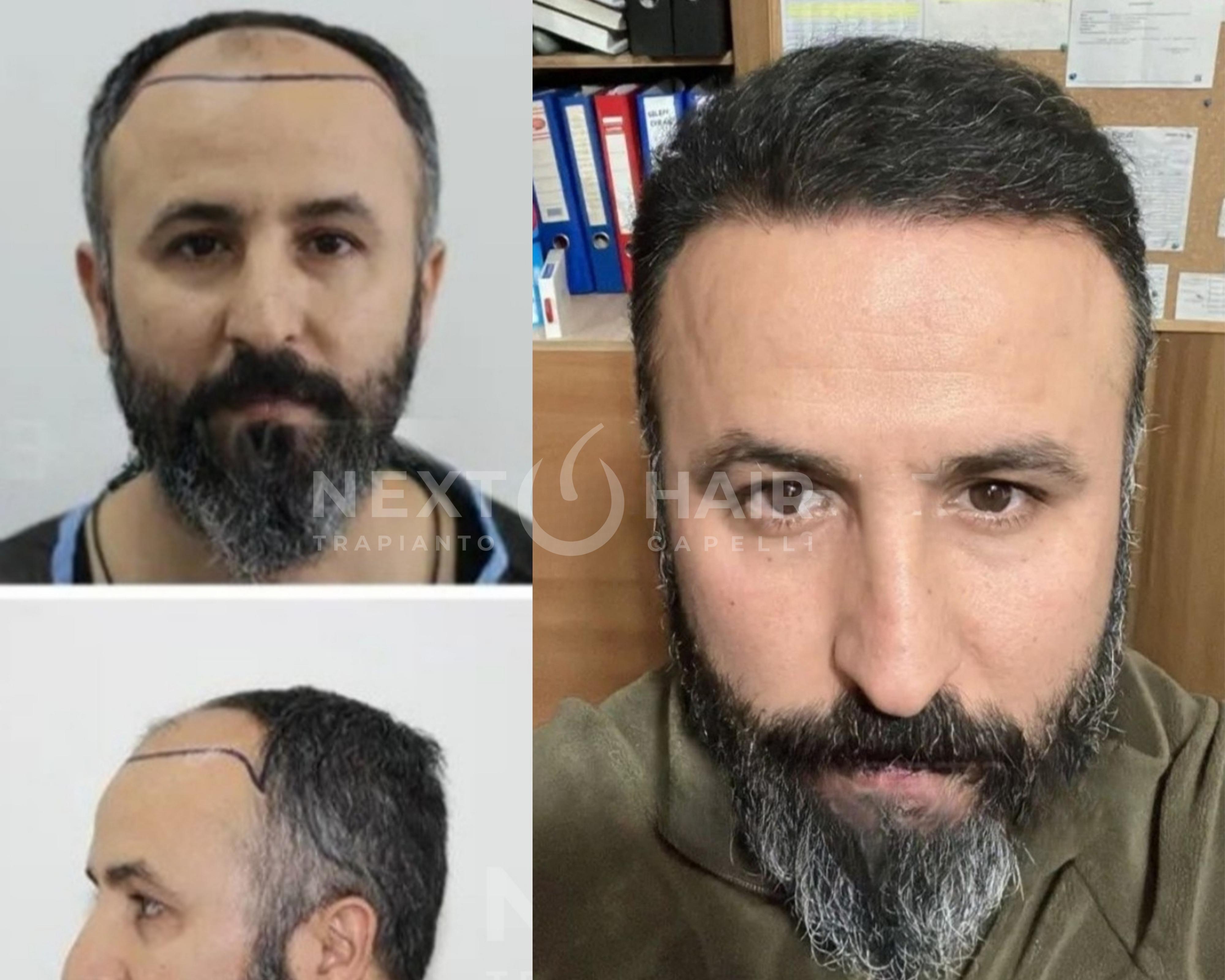 18 mesi dall'intervento. Tecnica FUE Zaffiro - 4500 UF