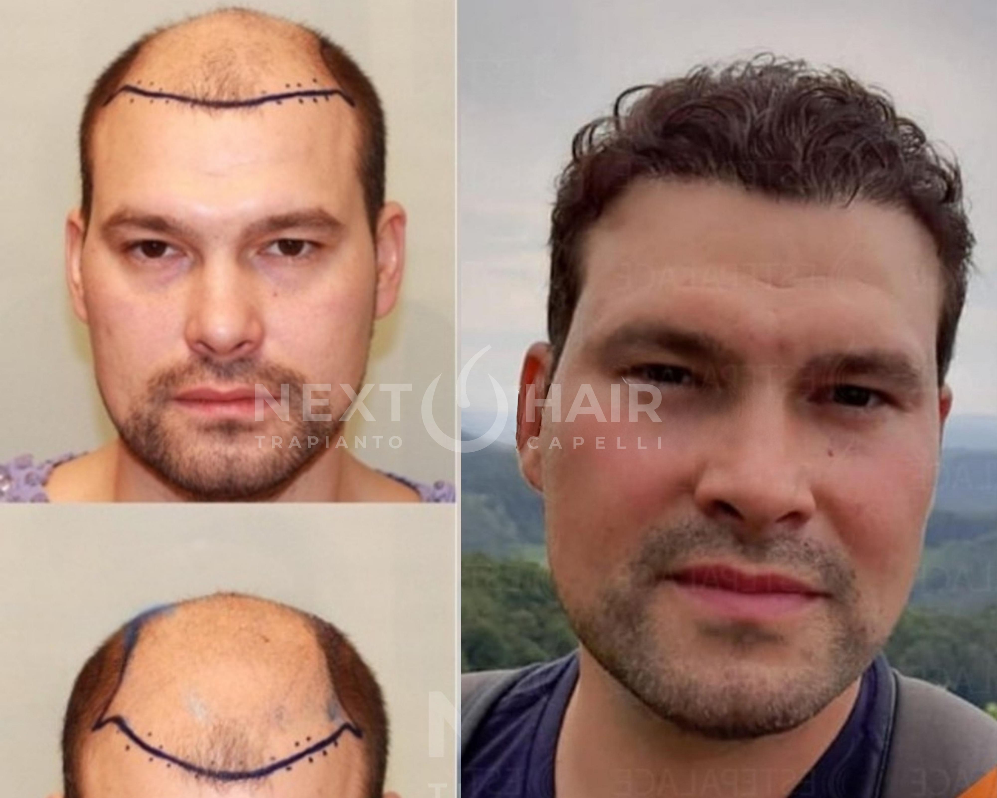 2 anni dall'intervento. Tecnica FUE - 5335 UF