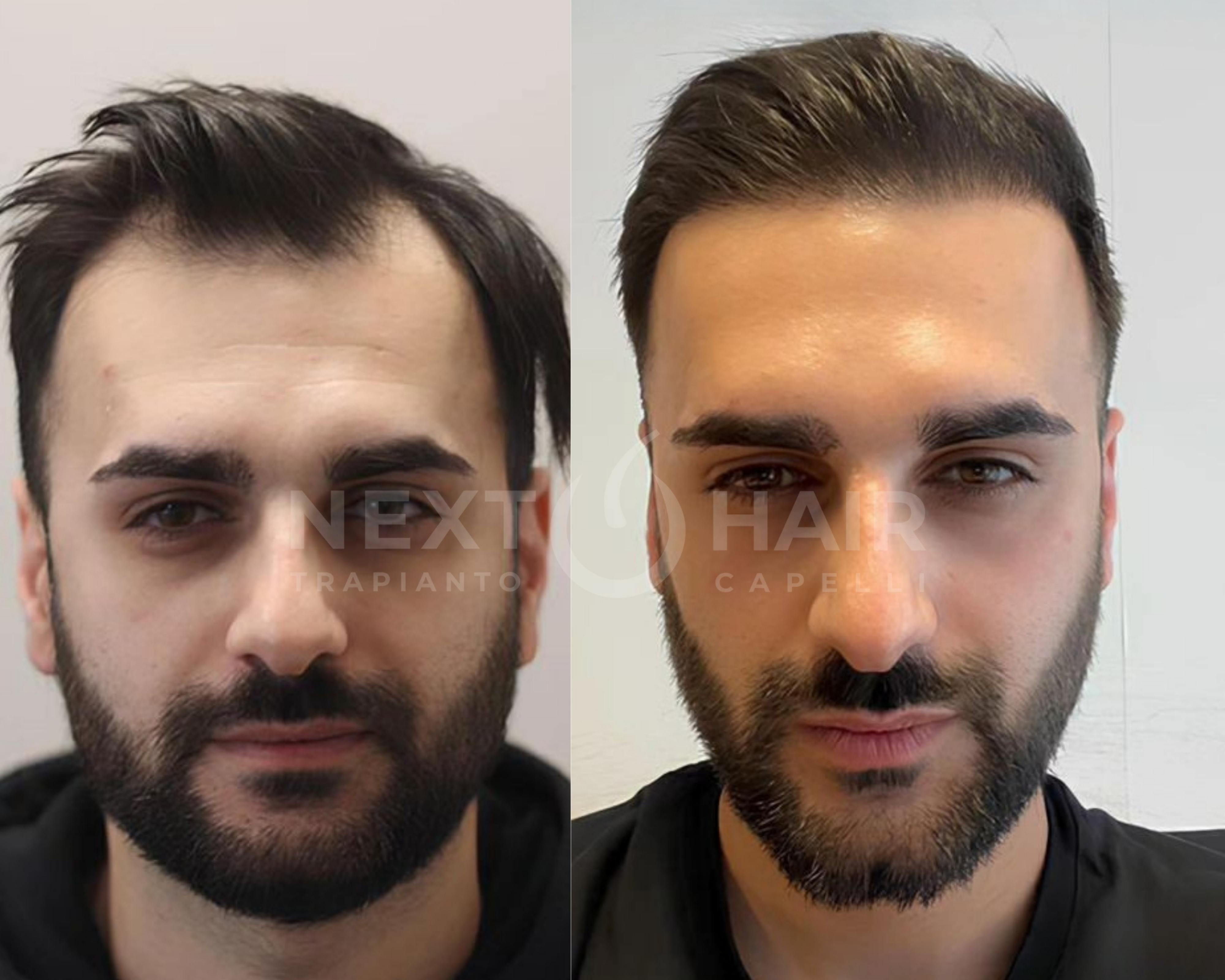 8 mesi dall'intervento. Tecnica DHI - 3800 UF