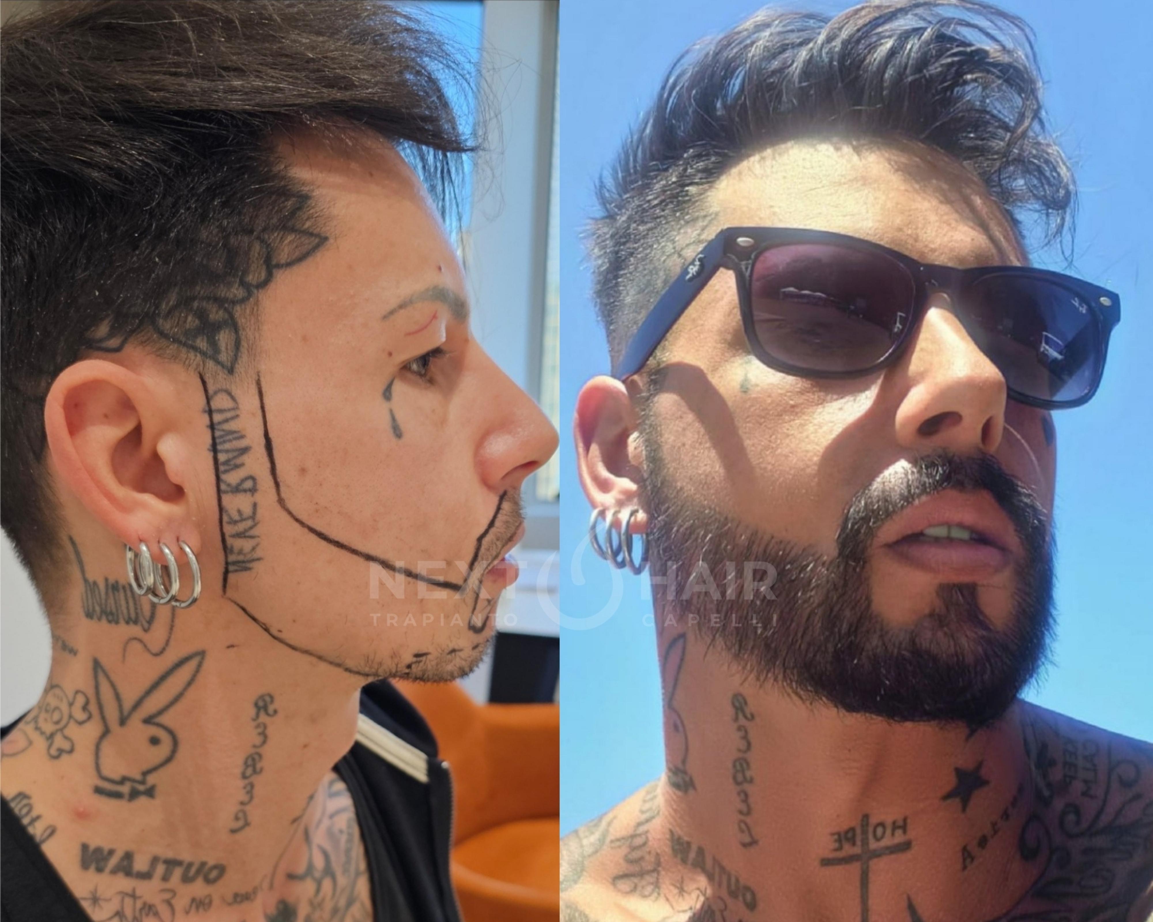 6 mesi dall'intervento. Barba - Tecnica DHI - 4500 UF