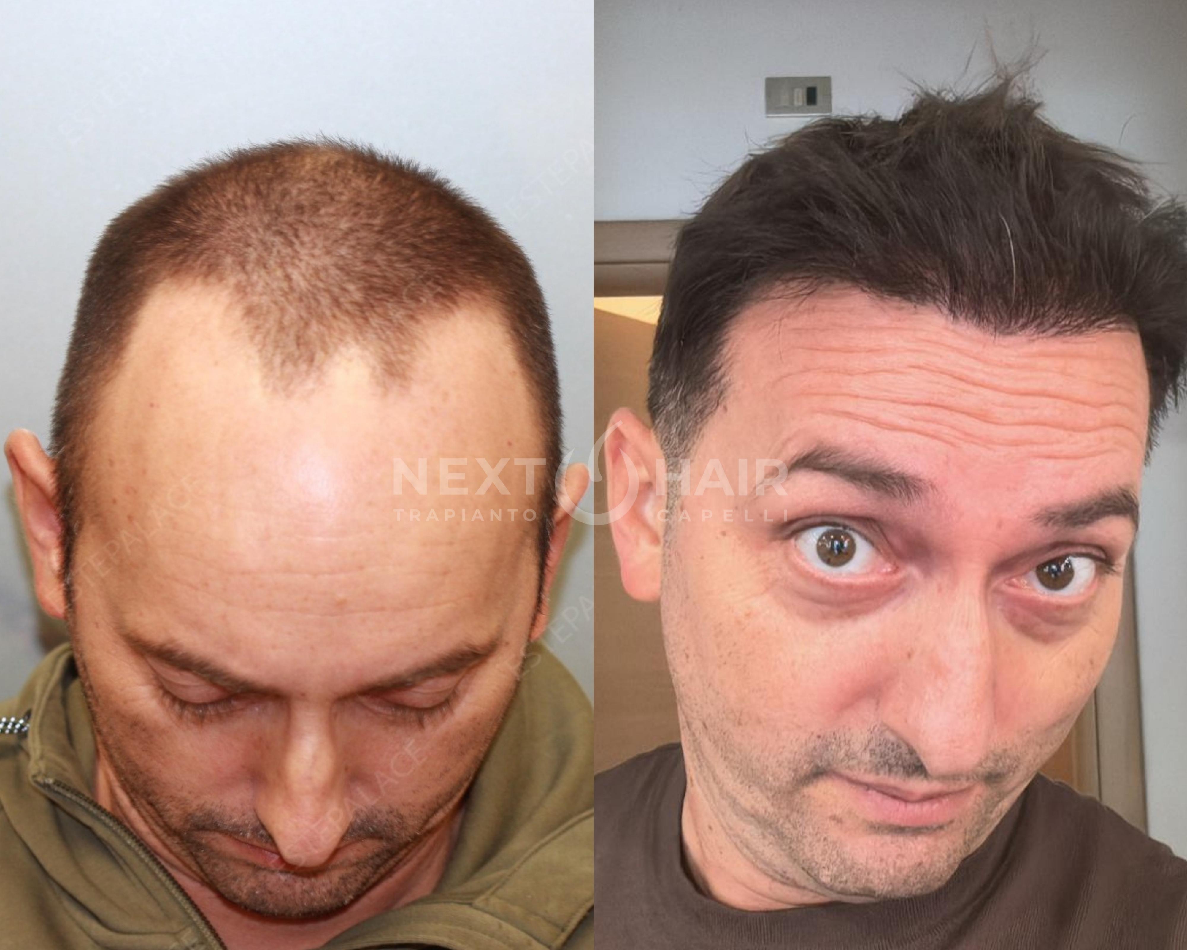 12 mesi dall'intervento. Tecnica FUE Zaffiro - 4600 UF