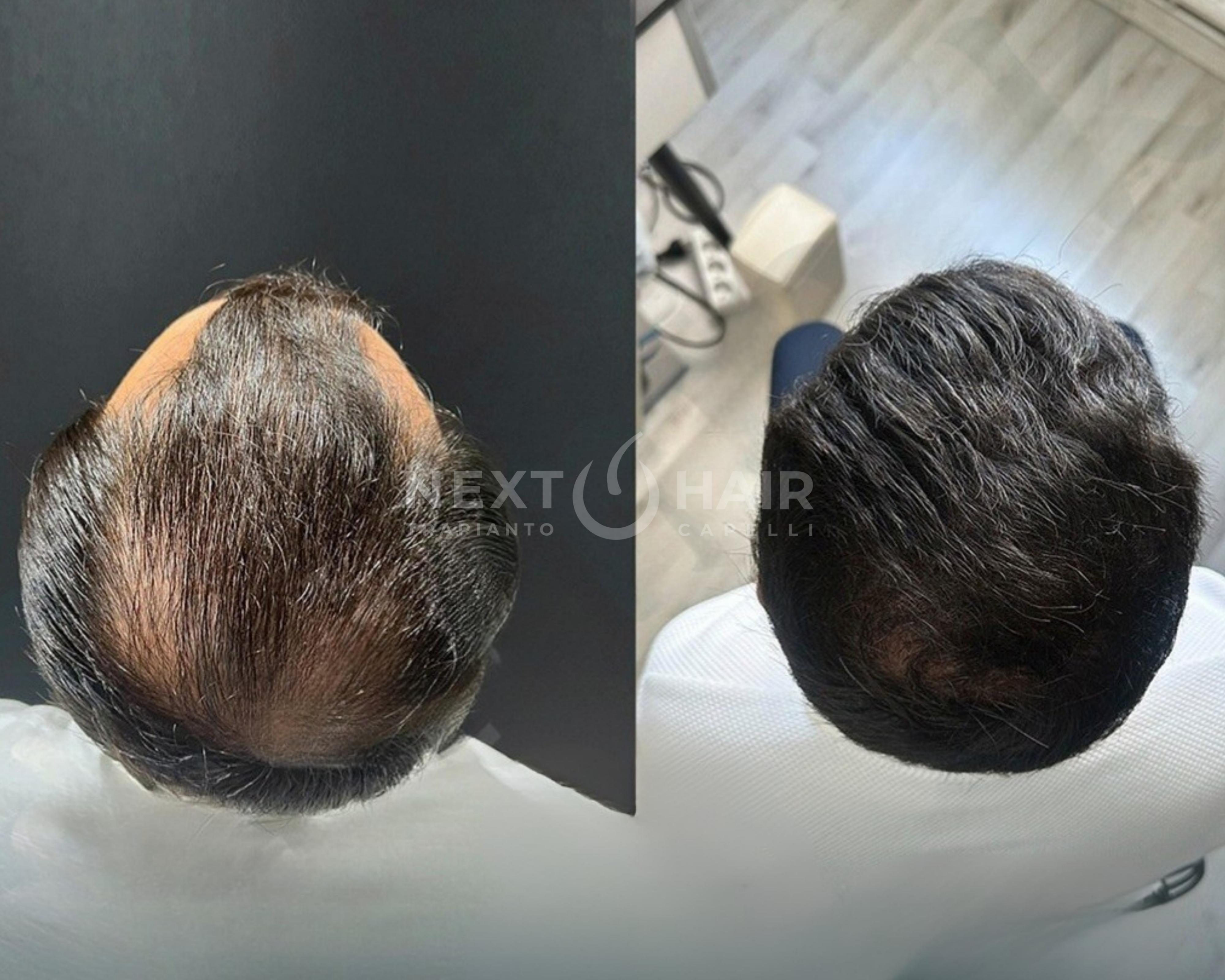 8 mesi dall'intervento. Tecnica DHI ad alta densità. Doppia sessione con 2 giorni consecutivi di operazione - 6400 UF