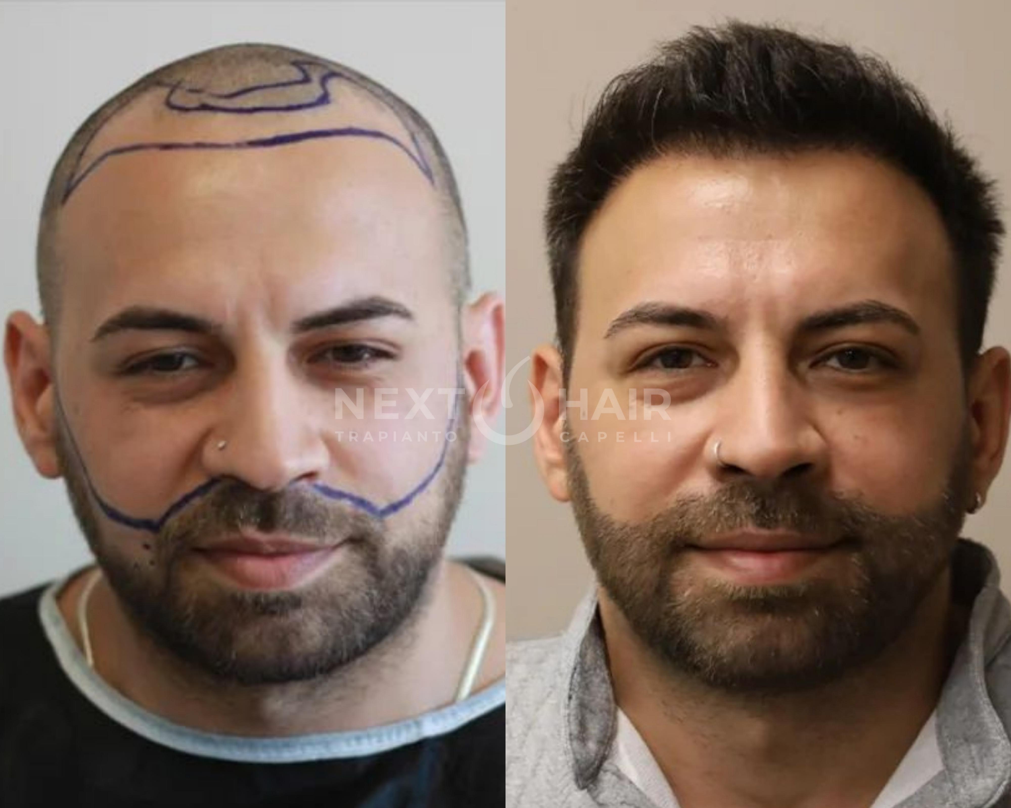 1 anno dall'intervento. Combo Barba & Capelli - Tecnica DHI - 4800 UF complessive
