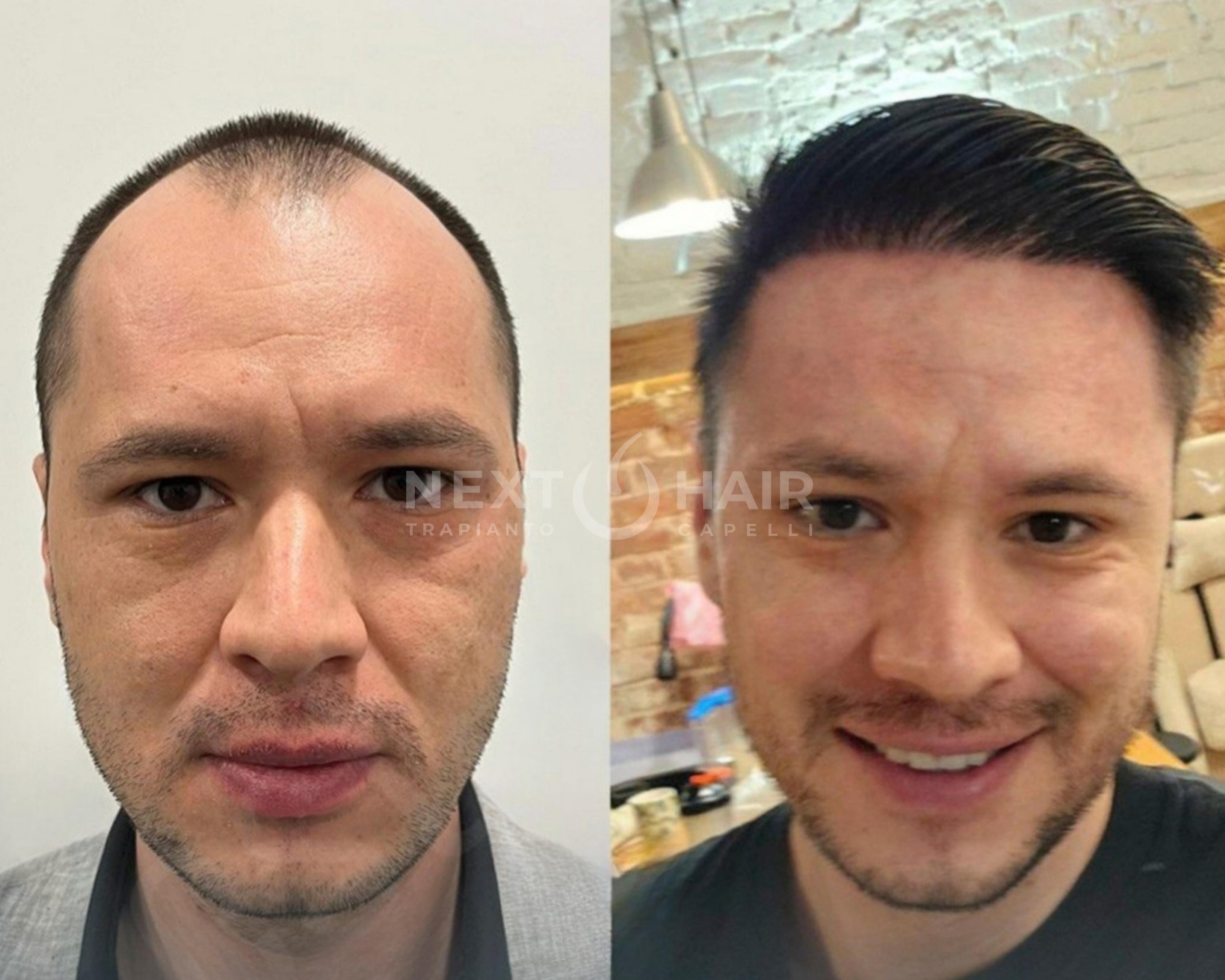 6 mesi dall'intervento. Tecnica DHI alta densità. Doppia sessione con 2 giorni consecutivi di operazione -  6230 UF