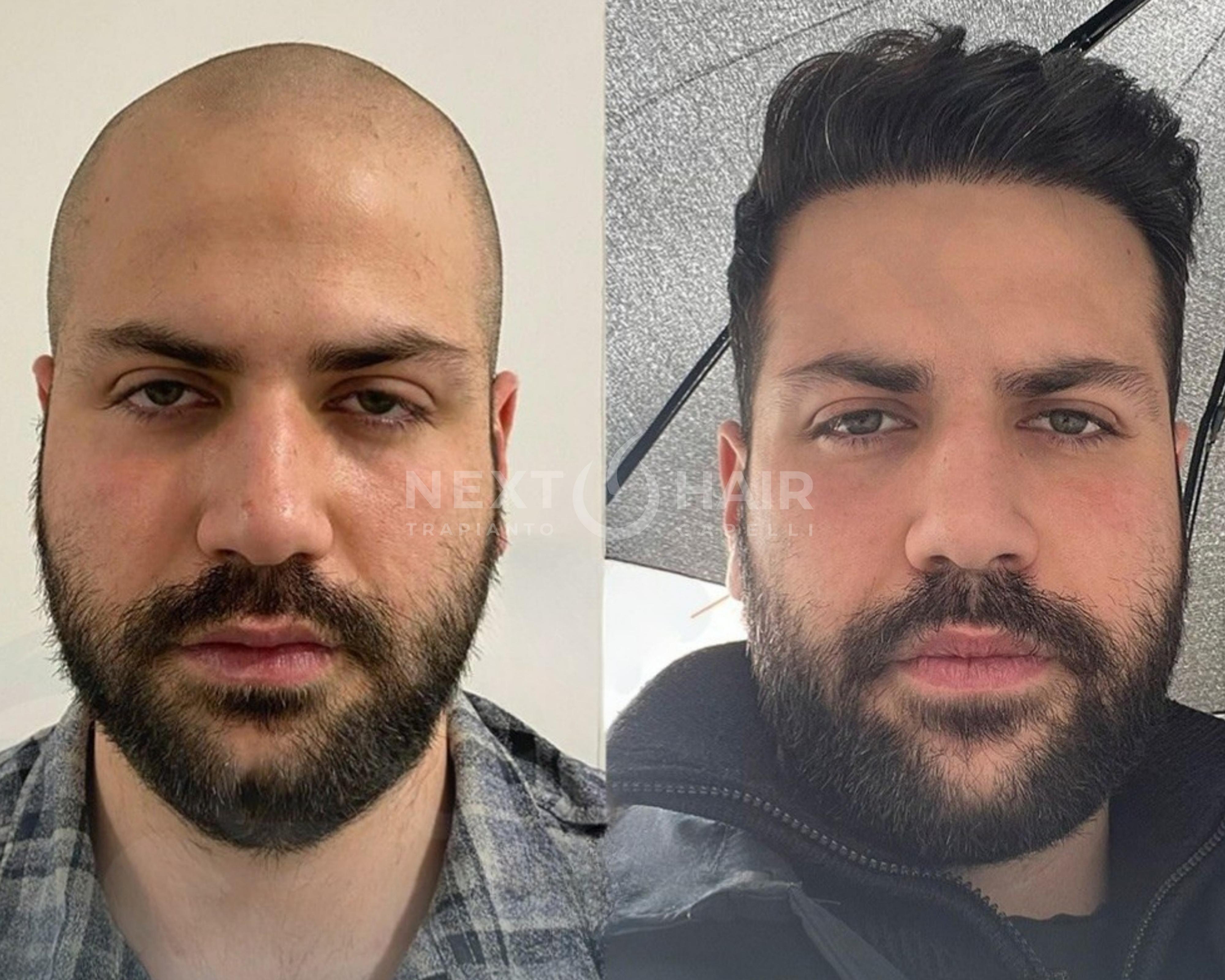 14 mesi dall'intervento. Tecnica DHI alta densità. Doppia sessione con 2 giorni consecutivi di operazione -  7280 UF