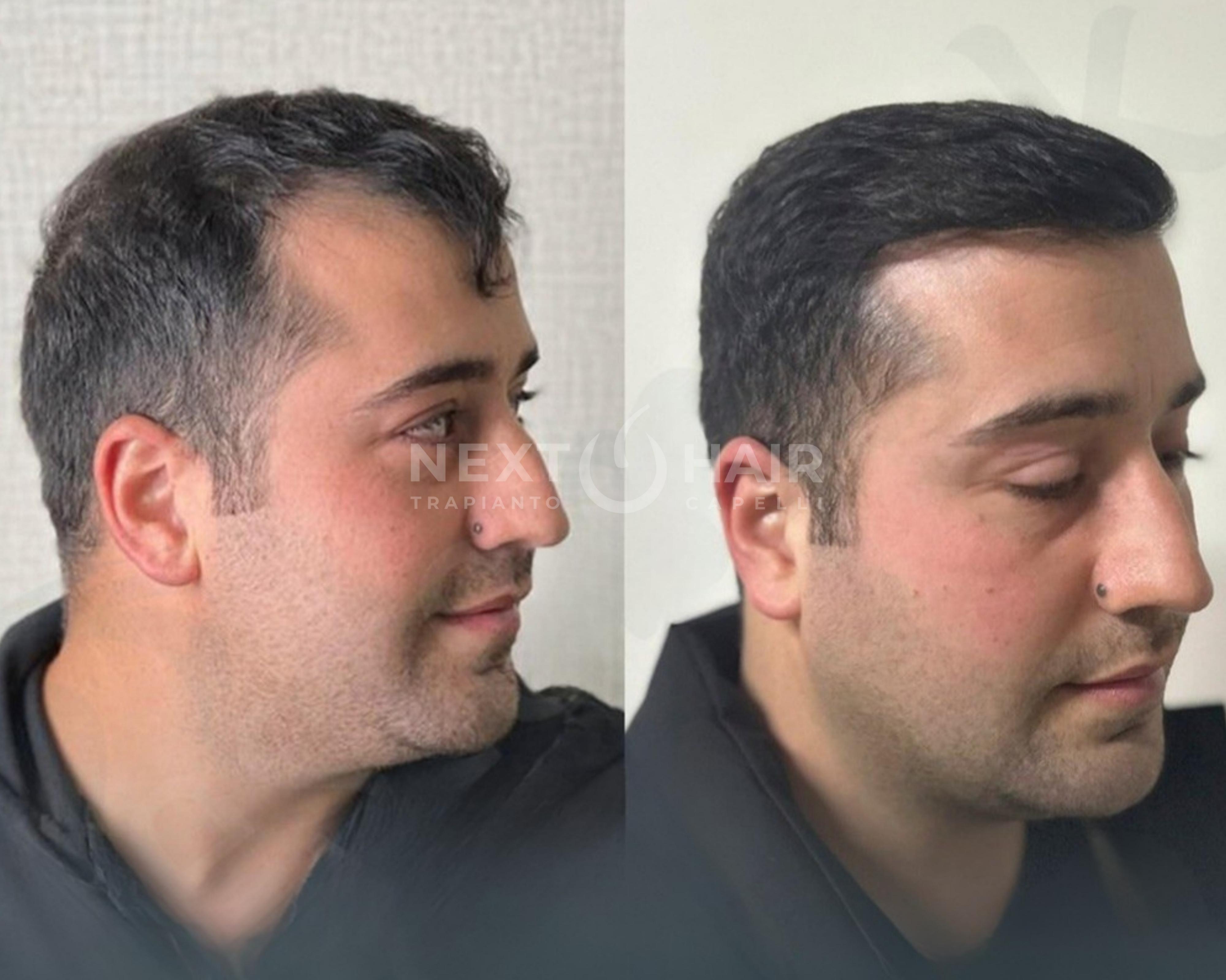 8 mesi dall'intervento.  Tecnica DHI - 4500 UF