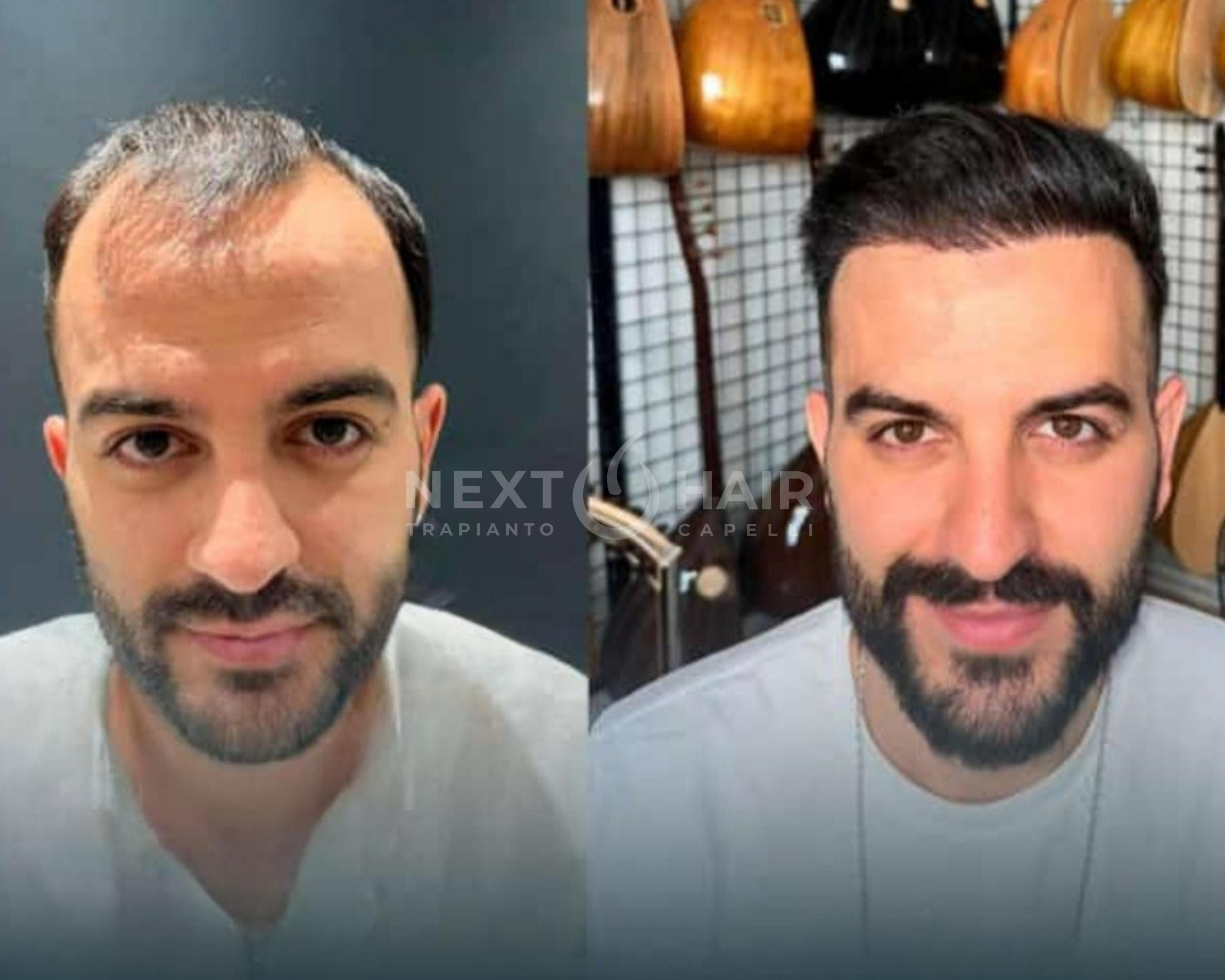 8 mesi dall'intervento. Tecnica DHI alta densità. Doppia sessione con 2 giorni consecutivi di operazione -  6400 UF