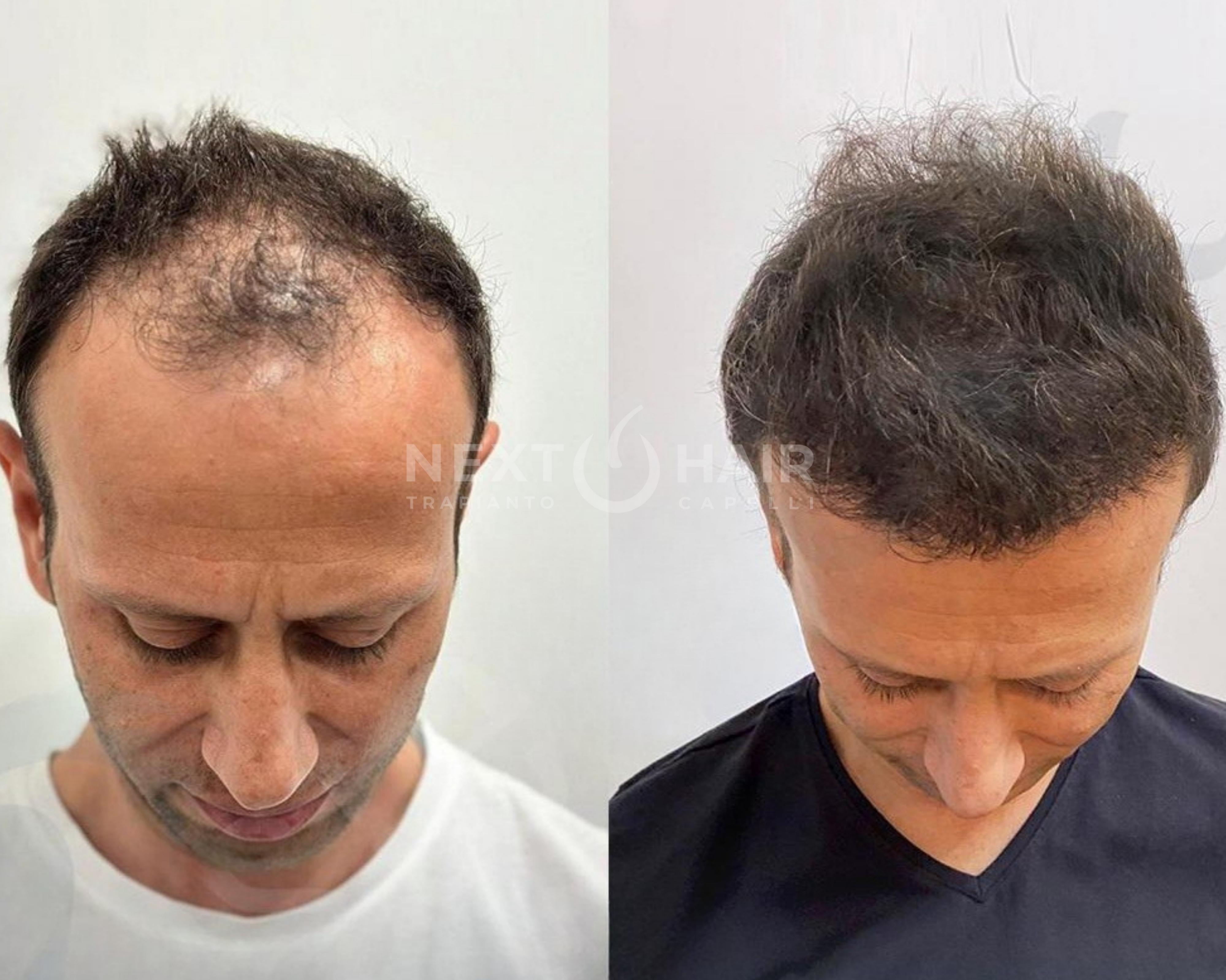 6 mesi dall'intervento. Tecnica DHI alta densità. Doppia sessione con 2 giorni consecutivi di operazione -  6600 UF