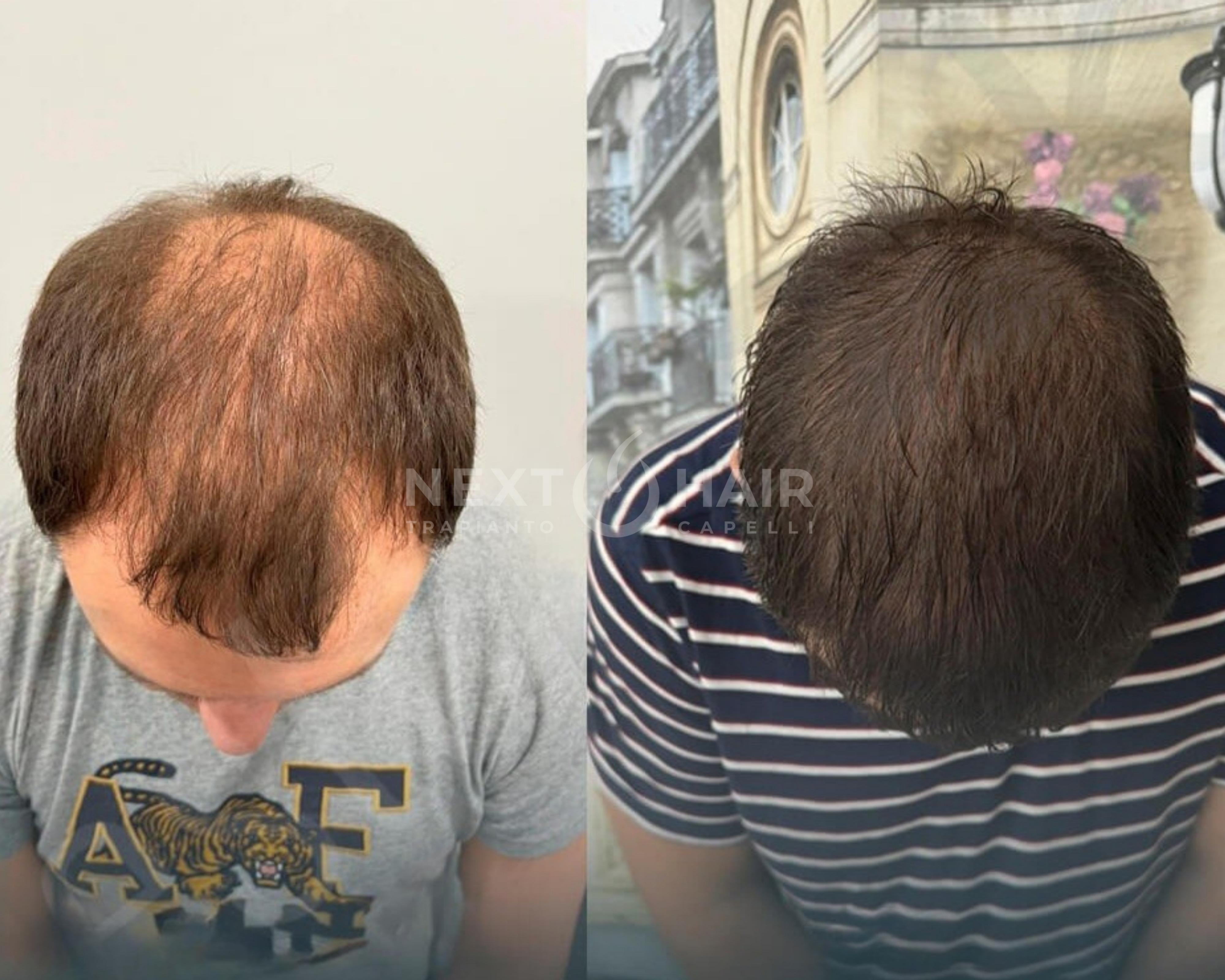 6 mesi dall'intervento. Tecnica DHI ad alta densità. Doppia sessione con 2 giorni consecutivi di operazione - 7100 UF