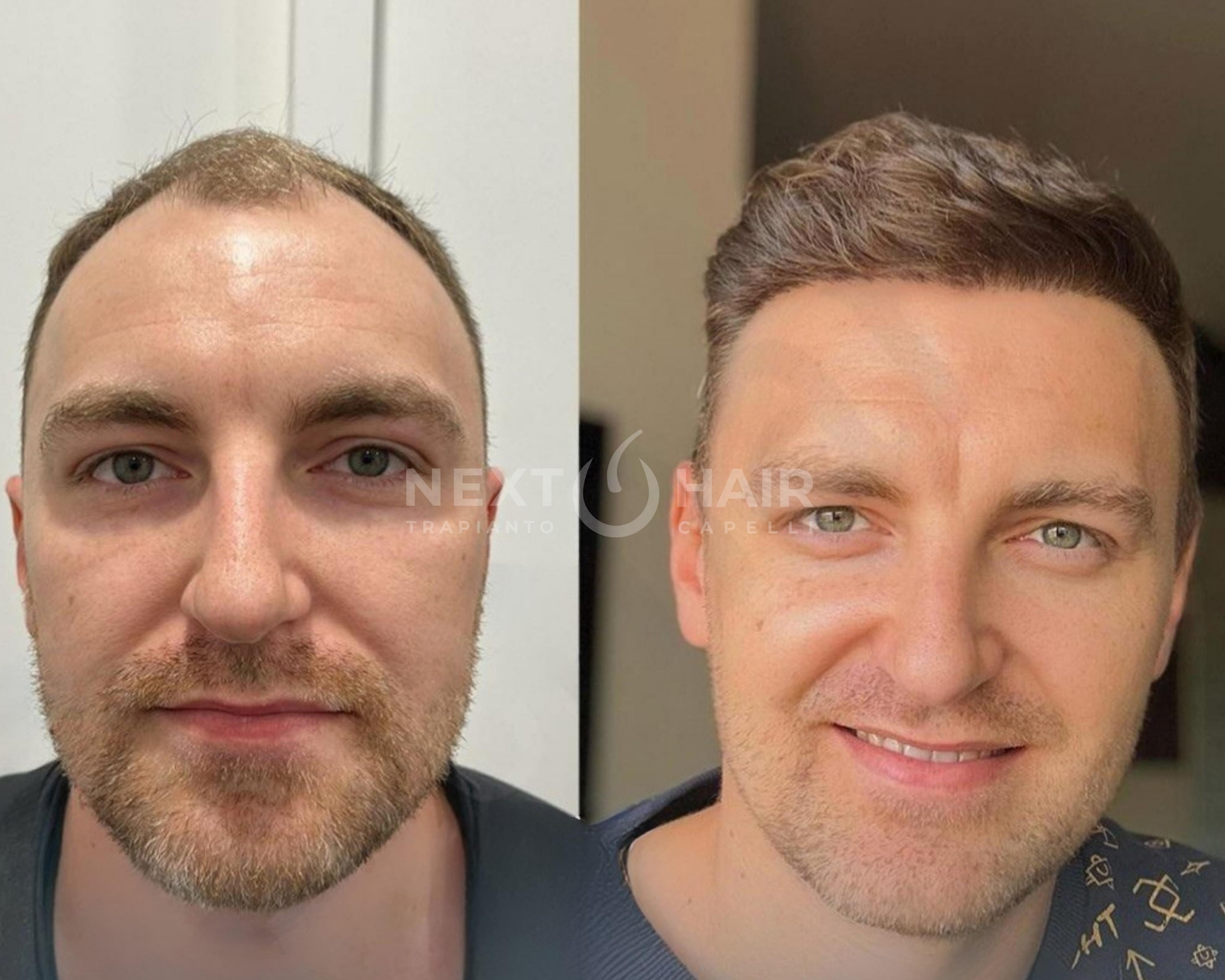 10 mesi dall'intervento. Tecnica DHI alta densità. Doppia sessione con 2 giorni consecutivi di operazione - 6115 UF 