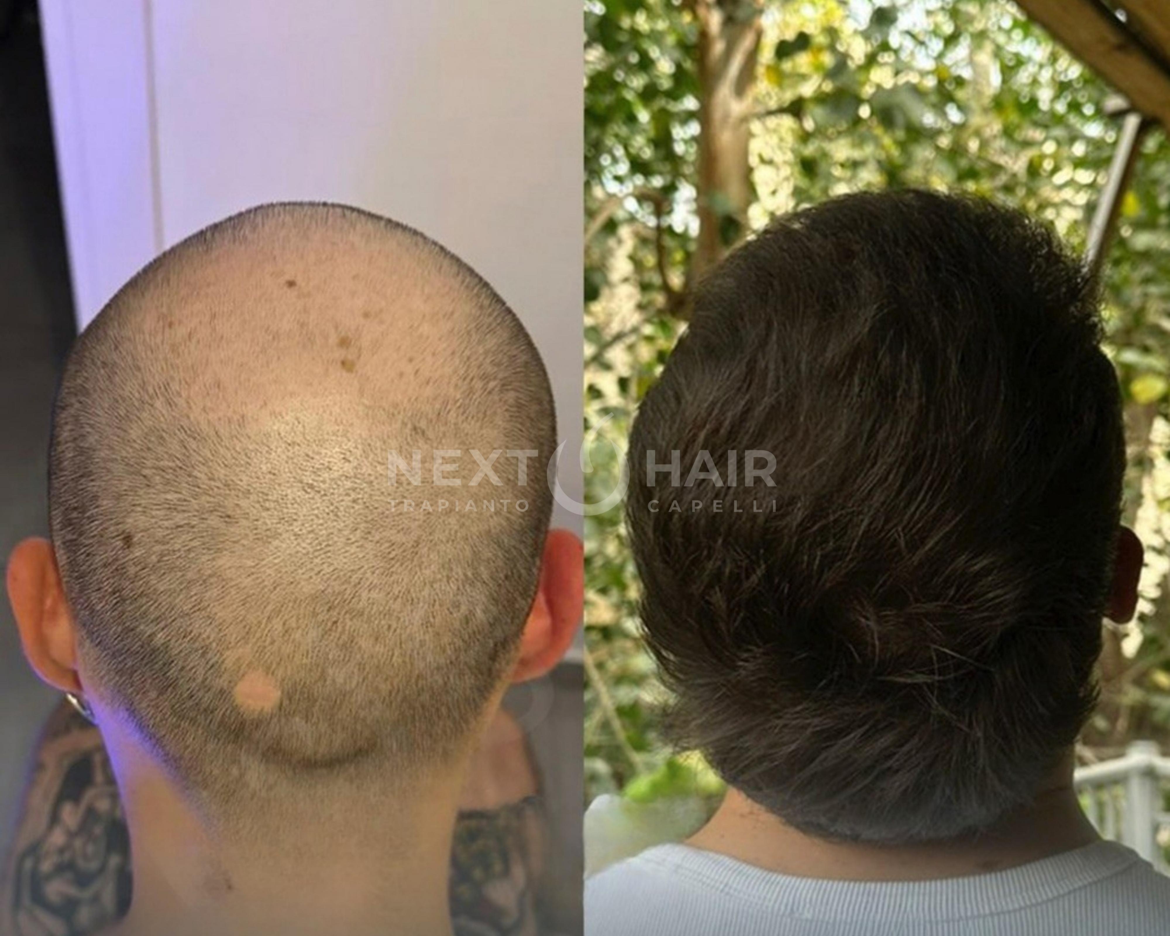 6 mesi dall'intervento. Tecnica DHI alta densità. Doppia sessione con 2 giorni consecutivi di operazione -  5900 UF