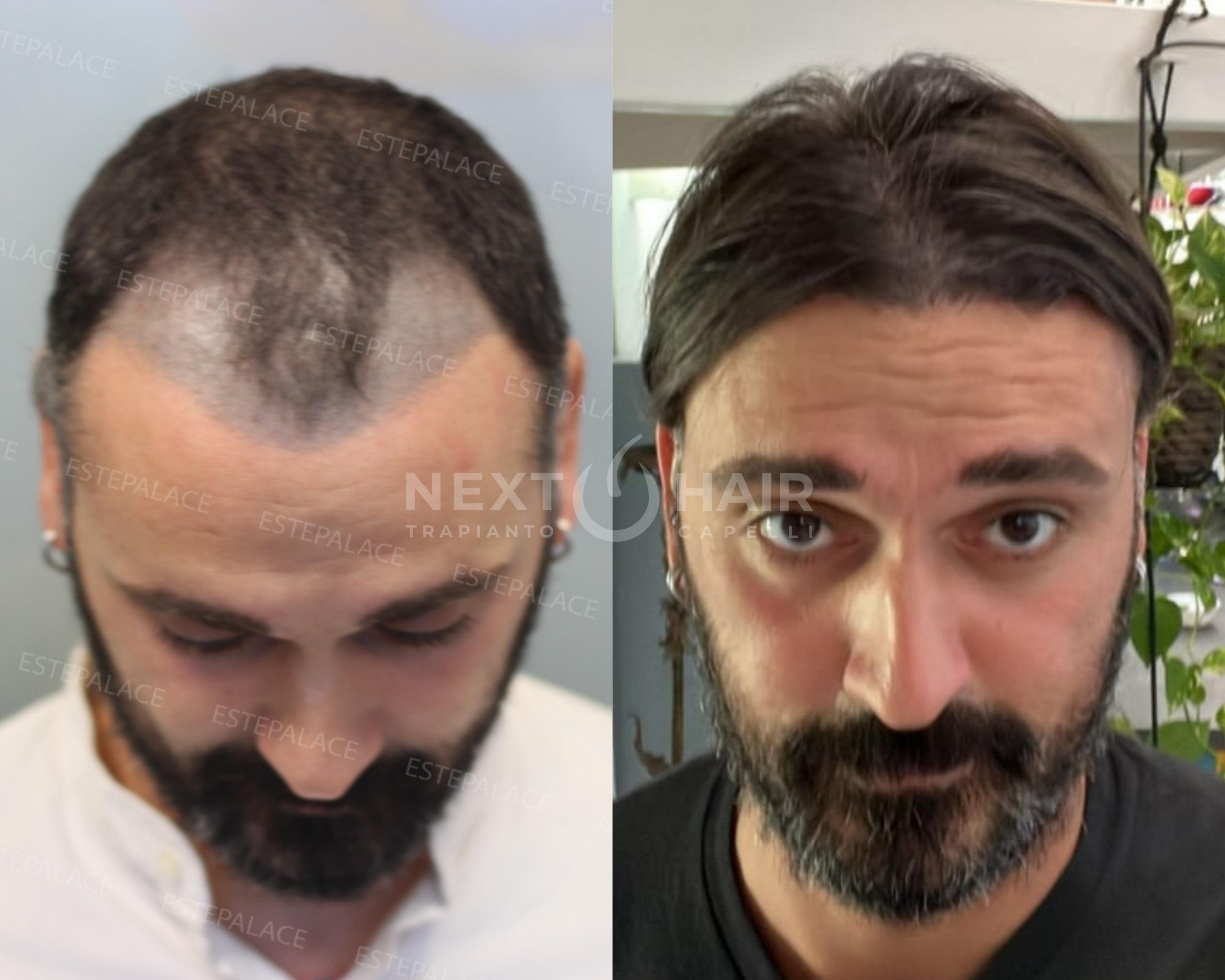 2 anni. Tecnica FUE Zaffiro - 4800 UF