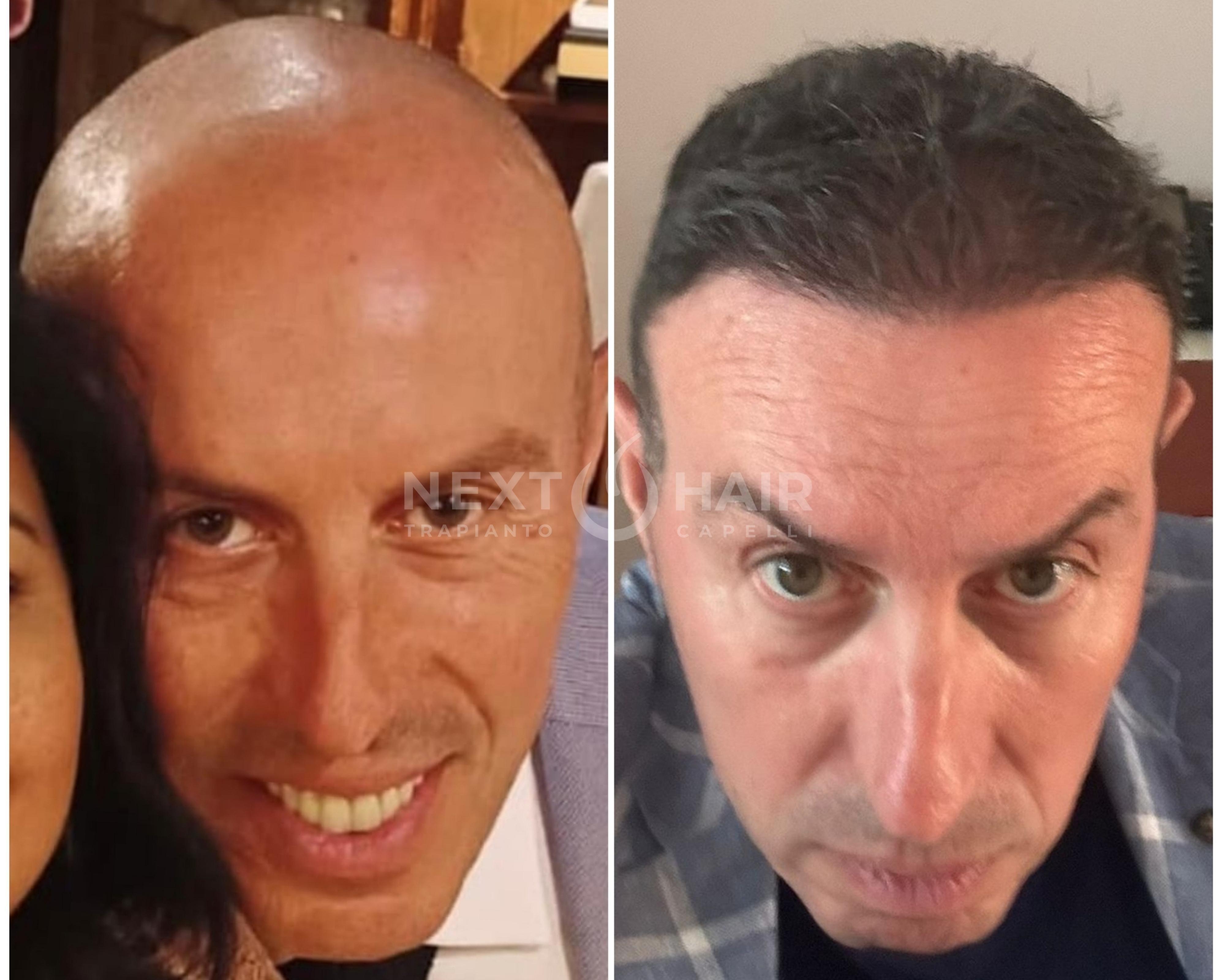 1 anno. Tecnica FUE Zaffiro - 4500 UF