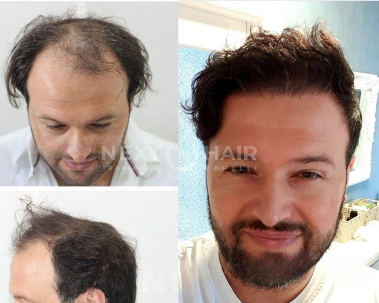11 mesi dall'intervento. Tecnica FUE Zaffiro - 5000 UF